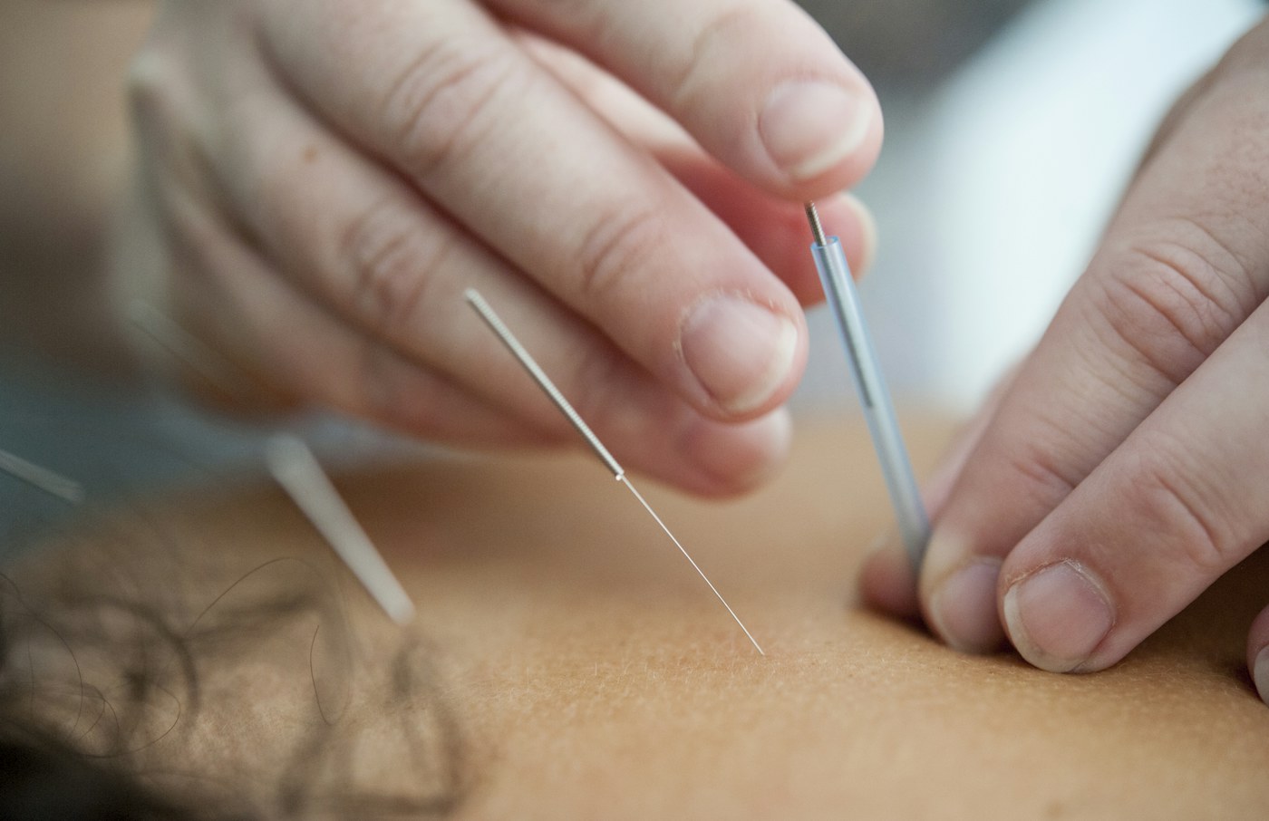 Acupuncture needles used during a professional treatment session