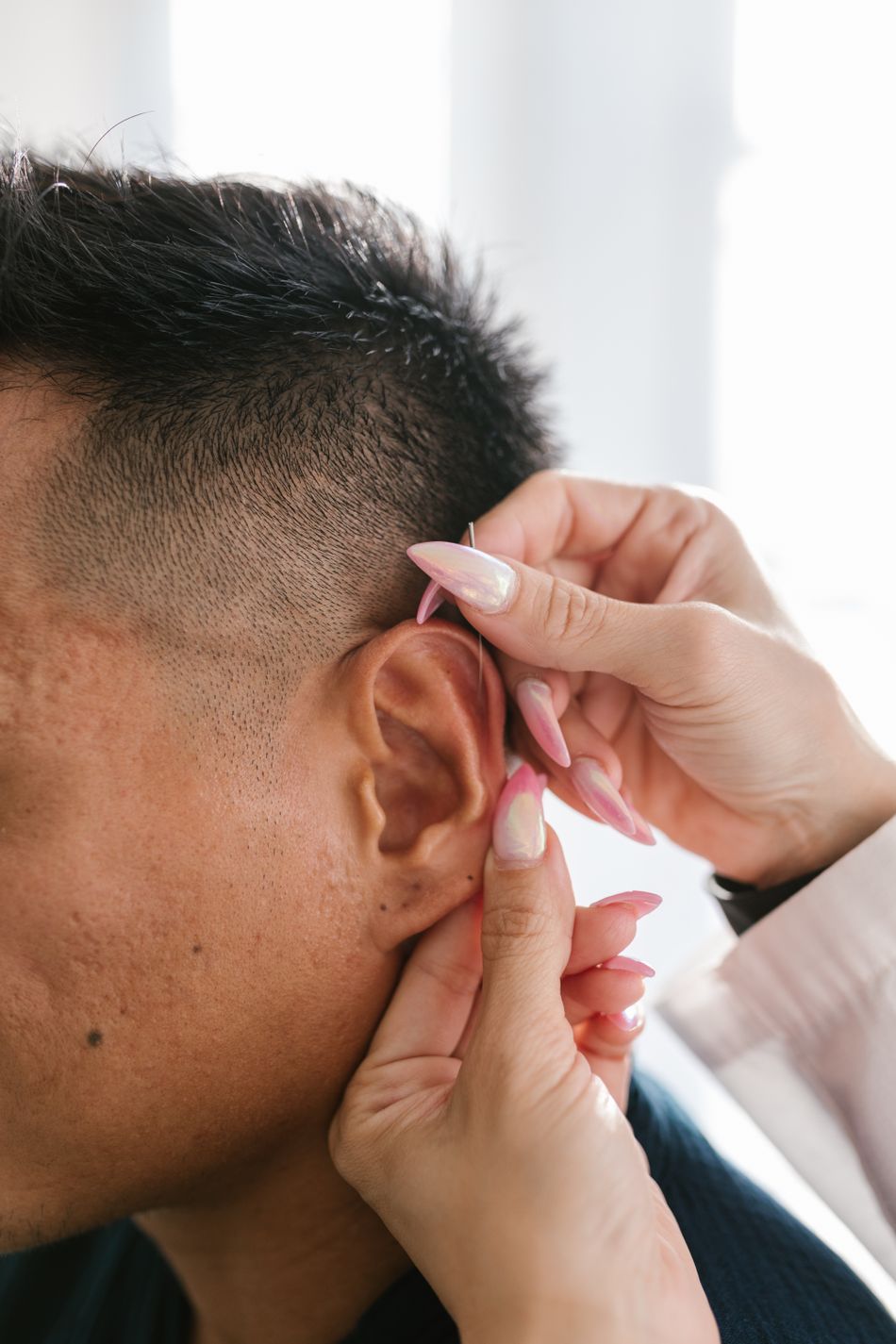 Ear acupuncture needle applied in a professional treatment demonstration