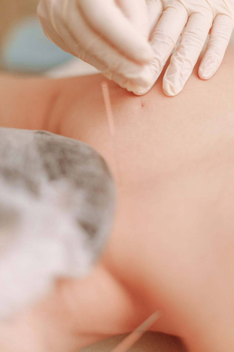 Fine acupuncture needles in use; illustrative image only, electrical stimulation equipment not pictured