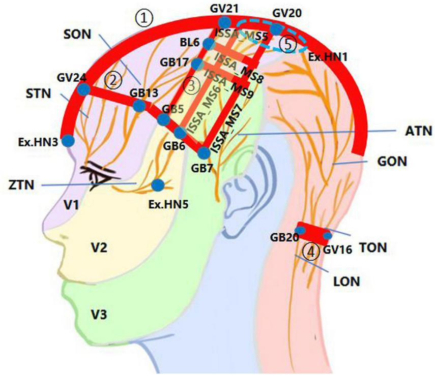 Clinical reference diagram showing scalp acupuncture zones